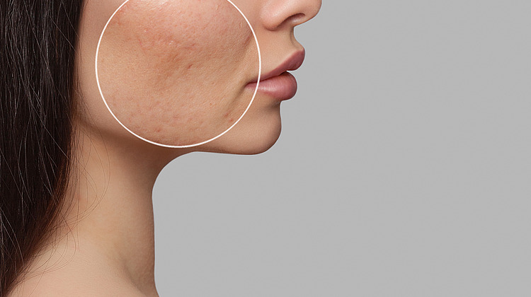 Controlling Skin Inflammation